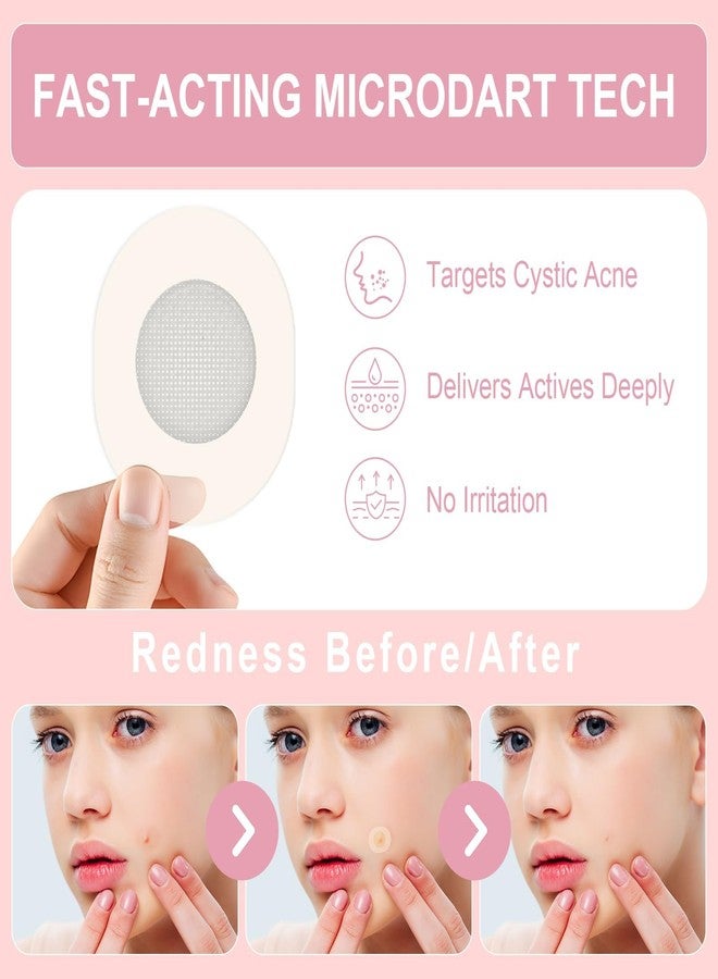 Vathery Pimple Patches Set with Microdart Pimples Patche and Hydrocolloid Patch – 3-Step Acne Kit for Fast Blemish Removal, Blackhead Extractor Tools, Zit Patches for Face - Image 4